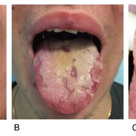 Gingival Overgrowth Caused By Cyclosporine In A Patient With Psoriatic