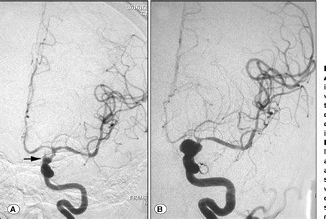 Figure 2 From Stent Assisted Coil Embolization Of Ruptured Supraclinoid
