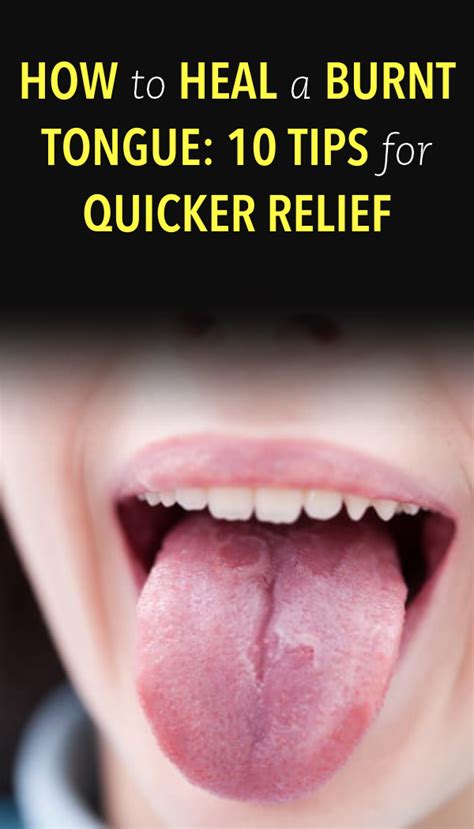 How To Heal A Burnt Tongue 10 Tips For Quicker Relief Burnt Tongue