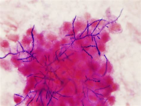 Figure2a Gram Stain ×1000 Of Sputum Showed Branching Gram Positive