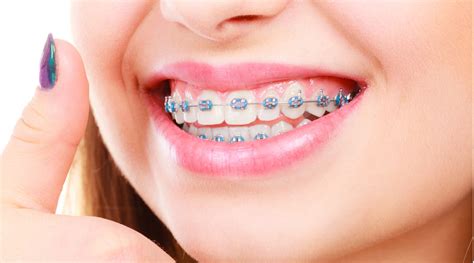 Consejos Y Cuidados De La Ortodoncia Con Brackets Estudi Dental Barcelona