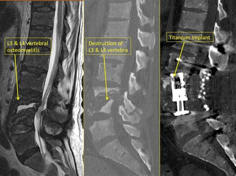 Spinal Infection Causes Symptoms And Treatments