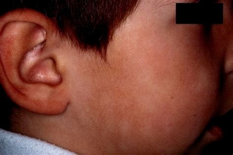 Pityriasis alba is so named for its scaly appearance (derived from the latin word pityrus, meaning bran) and characteristic white patches (alba, for white). Pityriasis alba | Primary Care Dermatology Society | UK