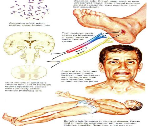 Tetanus Causes Symptoms Treatment Diagnosis And Prevention