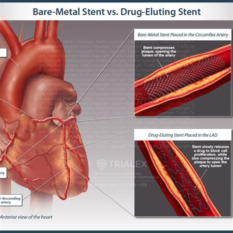 Bare Metal Stent Vs Drug Eluting Stent Trialexhibits Inc