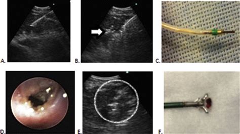Endobronchial Ultrasound Guided Cautery Assisted Transbronchial Forceps