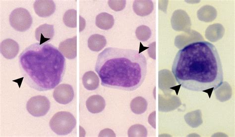 Granular Lymphocytes Cells And Smears