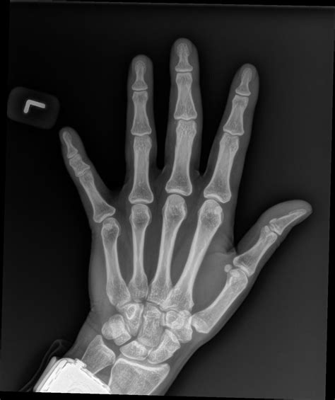 Orthodx Fracture Of Middle Finger Clinical Advisor
