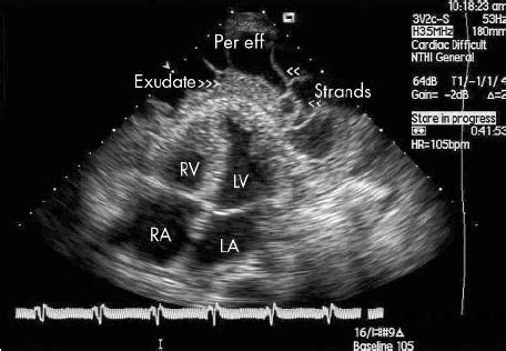 Apical Four Chamber View Of A Two Dimensional Echocardiogram Of A Download Scientific Diagram