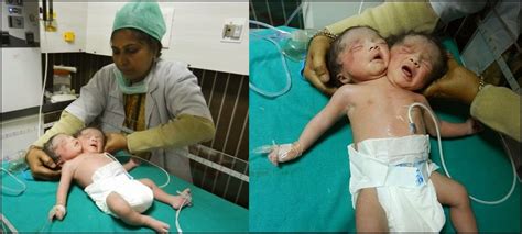 susan ibie blog photos woman gives birth to conjoined twins