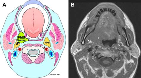 Imaging Of The Parapharyngeal Space Ento Key