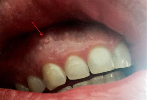 White Bump On My Gums R Dentistry