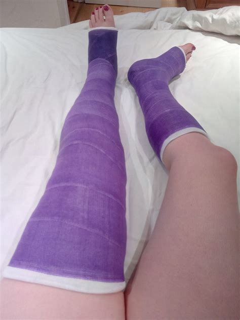 Long Leg Cast Tumblr