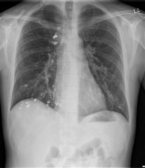 Chest X Ray Posteroanterior Pa Showing Location Of Multiple Pulmonary