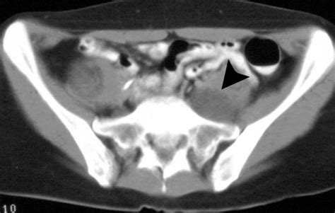 Abdominal Neoplasms In Patients With Neurofibromatosis Type 1