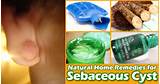 Images of Home Remedies Sebaceous Cyst