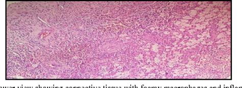 Figure 2 From Primary Xanthoma Of The Mandible A Case Report