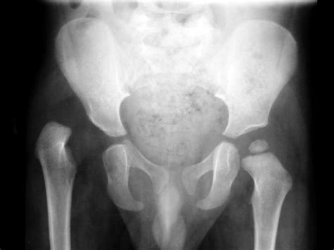 Radiograph Showing High Developmental Dysplasia Of The Right Hip In A Download Scientific