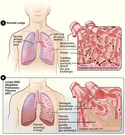 Fibrose Pulmonar Idiopática Wikiwand