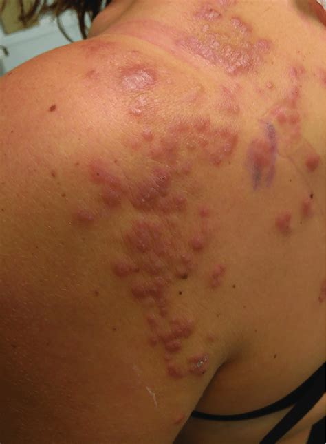 Sudden Onset Of Multiple Painful Erythematous Papules And Pustules My