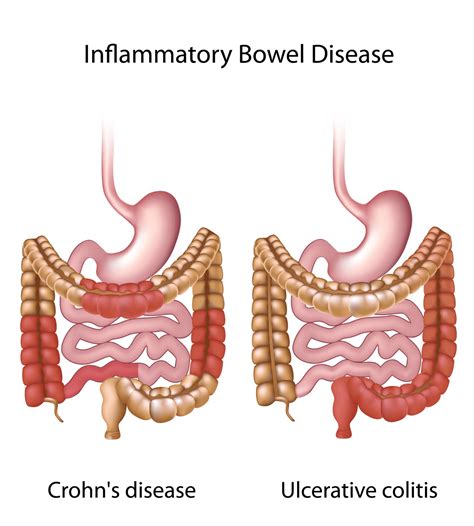 Inflammatory Bowel Diseases Types Causes And Treatment