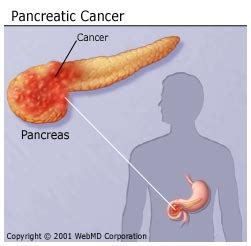 Pancreatic cancer treatment (pdq®) patient version. Opiniones de cancer de pancreas
