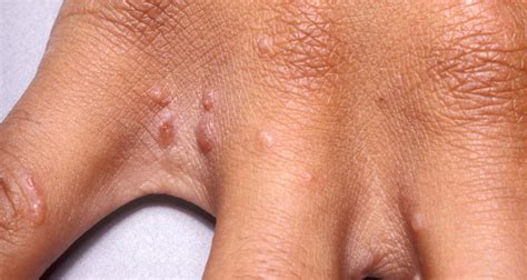 ينتمي المرض إلى أكثر الأمراض الطفيلية الجلدية شيوعًا وينتقل بسهولة من المريض إلى الأصحاء. إصابات بداء الجرب بين النازحين | جنوبية