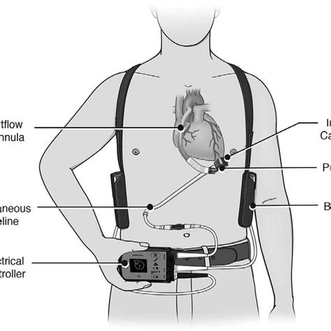 Basic Left Ventricular Assist Device Components Image Reproduced With