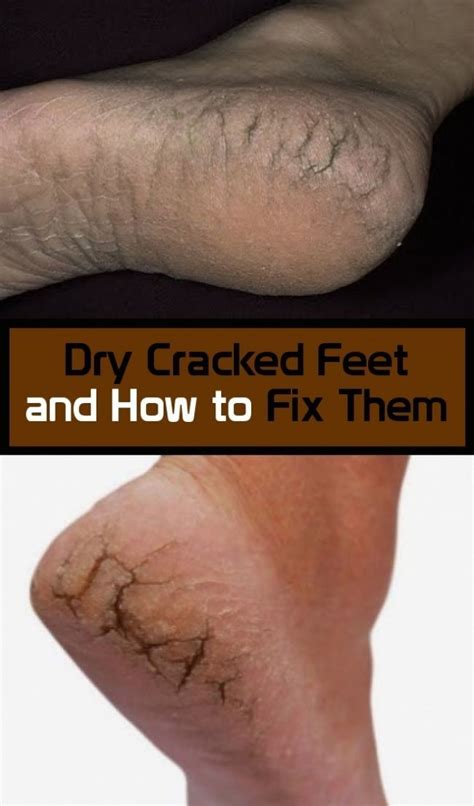 Dry Cracked Feet And How To Fix In 2020 Dry Cracked Feet Cracked