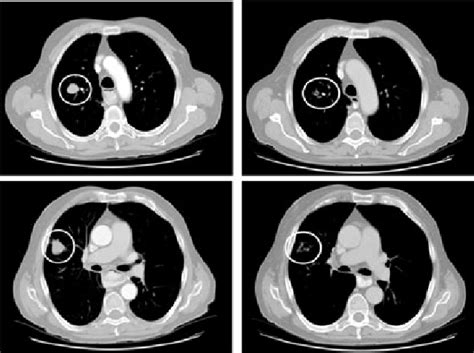 Ct Scan Of Lungs In Patient Id 02 026 Metastatic Adenocarcinoma Of