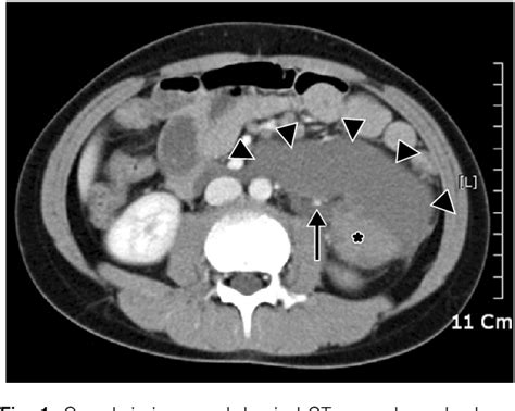 Figure 1 From A Case Of A Retroperitoneal Cystic Lymphangioma Treated