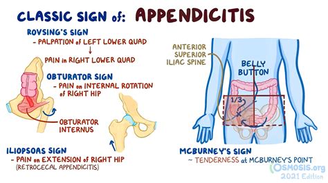 Keith Siau On Twitter Classical Signs Of Acute Appendicitis