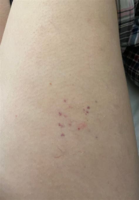 Is This Petechiae Appeared On My Thigh Overnight Skin