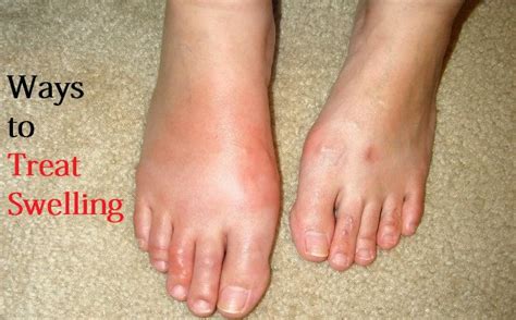 How To Treat Swelling