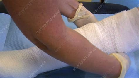 Leg Ulcer Dressing Stock Video Clip K0033865 Science Photo Library