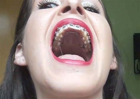 Braces Braceface Metalbraces Girlswithbraces Quadhelix Orthodontie Dents
