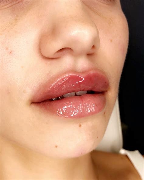Subtle Lip Fillers Best Clinic Sydney For Dermal Fillers