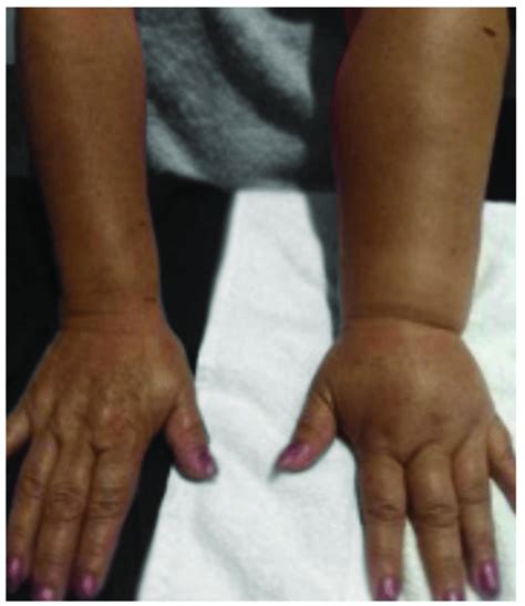 Secondary Lymphedema Caused By Mastectomy With Lymphadenectomy