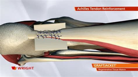 Graftjacket™ Regenerative Tissue Matrix Achilles Animation 009128