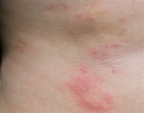 How To Deal With Postpartum Hives Top 10 Home Remedies