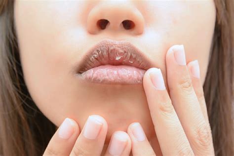 Home Remedies To Cure Chapped Lips Holistic Living Tips