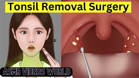 Asmr Watch A Tonsillectomy Operation Tonsil Removal Surgery Animation