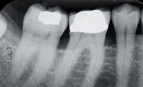 Others recommend that they get baby teeth xray as often as convincing, which would be dictated by your pediatric dentist. Dental X-Rays (0-11yrs) - Your Dental Health | Australian ...