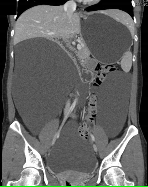 Loculated Ascites In Ovarian Cancer Obgyn Case Studies Ctisus Ct