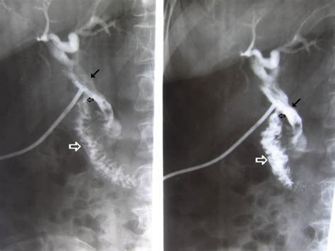 The Post Operative T Tube Cholangiography It Is Demonstrating A