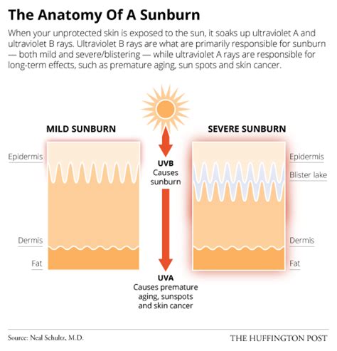 The Anatomy Of A Sunburn