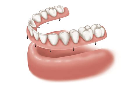Getting used to either partial or full dentures takes several weeks to months, as the tongue and cheeks are conditioned if you feel like you have to use an adhesive to make your dentures fit, it may be. Partial Dentures - Woodcrest Dental