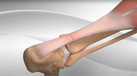 Achilles Ruptures — Daniel Bohl Md Midwest Orthopaedics At Rush