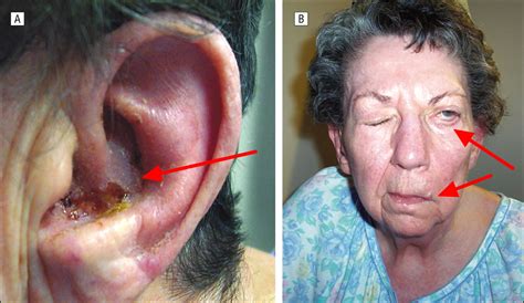 Ramsay Hunt Syndrome Causes Symptoms Recovery Time And Treatment