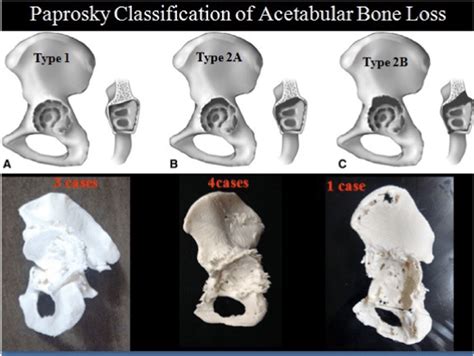 A Paprosky Classification Of Acetabular Defects And The Corresponding